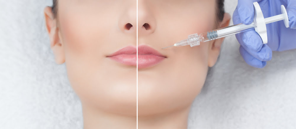 Quanto custa uma aplicação de botox no rosto? 2 harmonizacao facial
